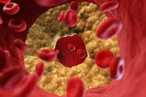 Keto cholesterol (4) An illustration of a partially blocked artery