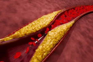 Cholesterol Atherosclerosis and plaque buildup in blood vessels due to high cholesterol