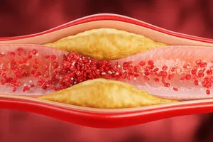 heart health Illustration of Blood plaque.