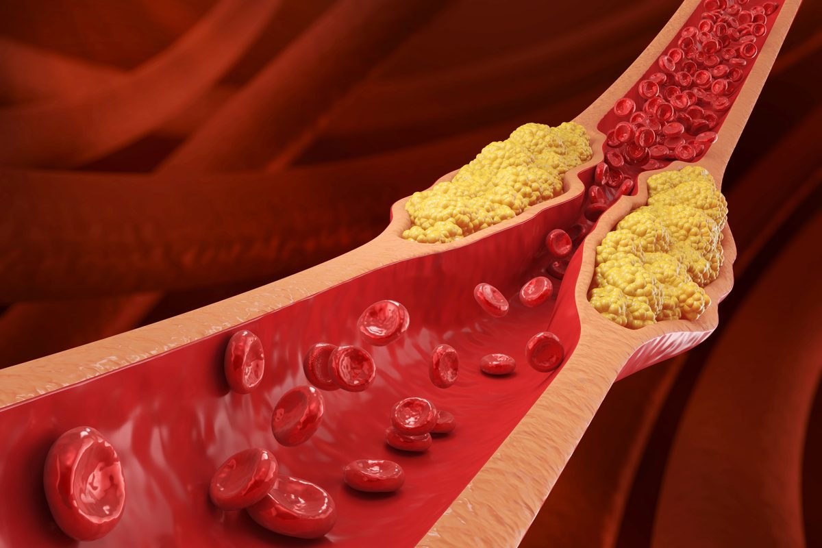 This is the single best way to reduce your cholesterol without statins, according to a leading doctor