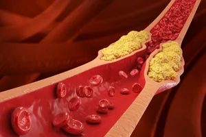 high cholesterol