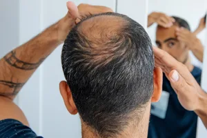 balding-health Bald man looking in a mirror at head baldness and hair loss