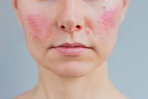 How to stop rosacea flare-ups A close-up of a woman's face with rosacea