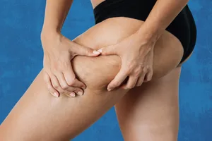 GettyImages-1500559188 Close up of woman inspecting cellulite against a blue background