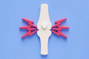 An illustration of a bone joint with zigzag lines representing arthritis An illustration of a bone joint with zigzag lines representing arthritis